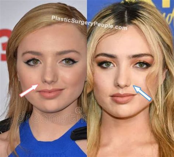 Peyton List Plastic Surgery Before and After